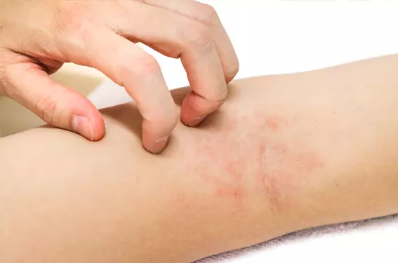 Eczema